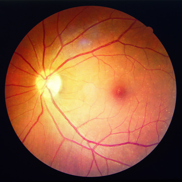 Retina and Uveitis Center | Artificial Iris, Floaters and Sarcoidosis